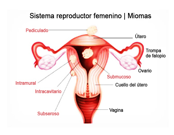 efectos de los miomas