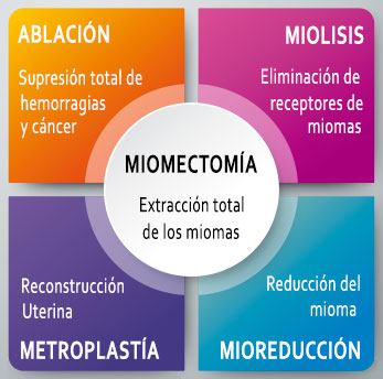 Tratamiento del mioma