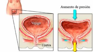 incontinencia urinaria