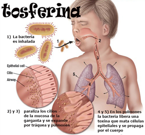 la tosferina en el embarazo