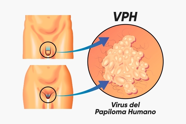 infección del virus de papiloma en Granada