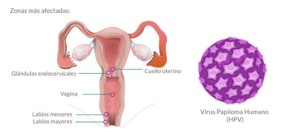 tipos del virus del papiloma en granada