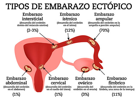 embarazo ectópico