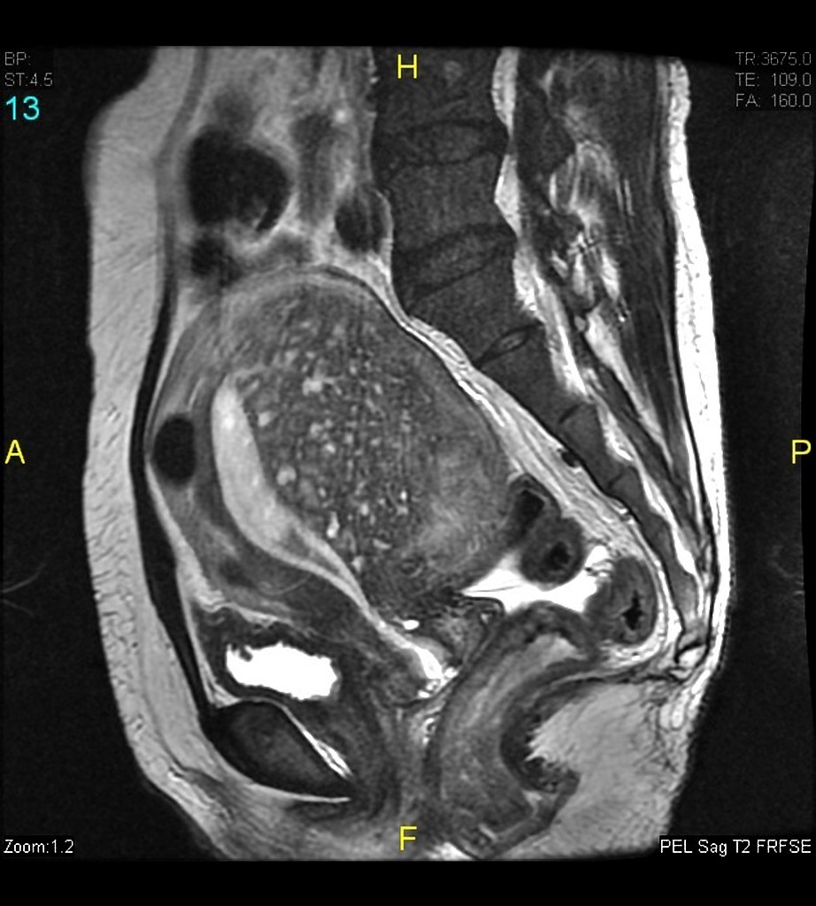 pruebas adenomiosis