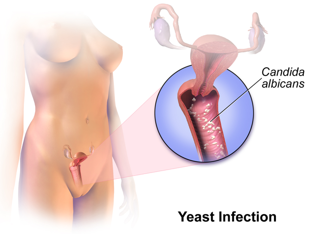 candidiasis vaginal