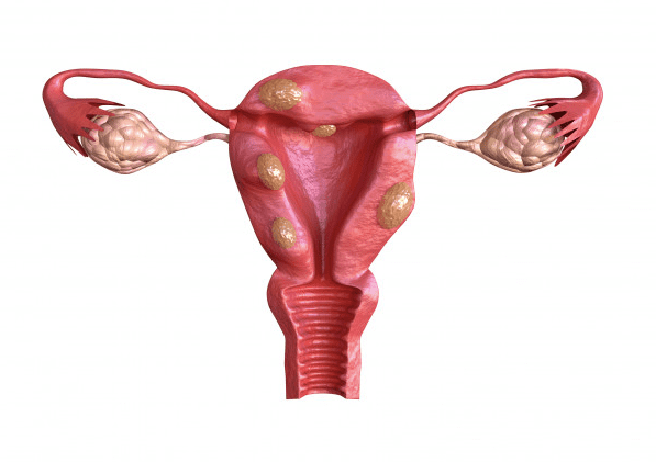 Fibromas Uterinos