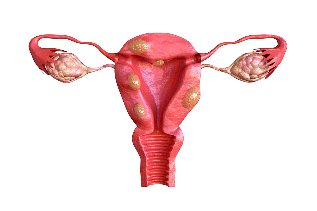 Fibromas Uterinos